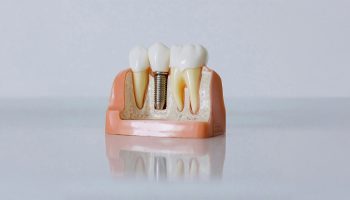 What Are Dental Implants and How Do They Work?
